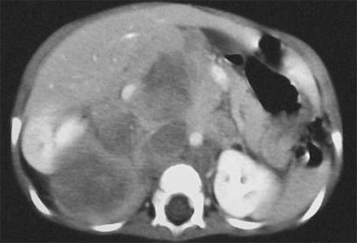CT – Bild eines Neuroblastomes vor der re. Niere, die abgedrängt vorliegt.