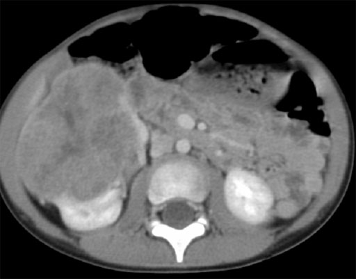 CT eines Wilms Tumors der rechten Niere. 