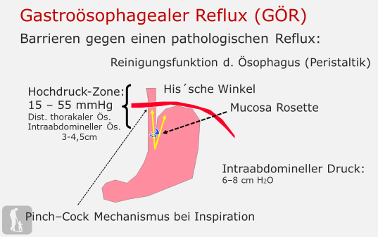 Gastroösophagealer Reflux - 02