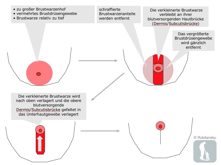 Der in pubertät brust knoten Was bedeutet