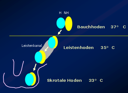 Hodenhochstand