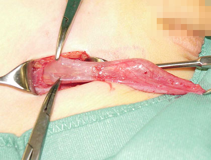 Präparation des Processus vaginalis peritonei