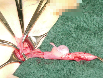 Der offene Processus vaginalis peritonei ist mobilisiert und hochgeschlagen.