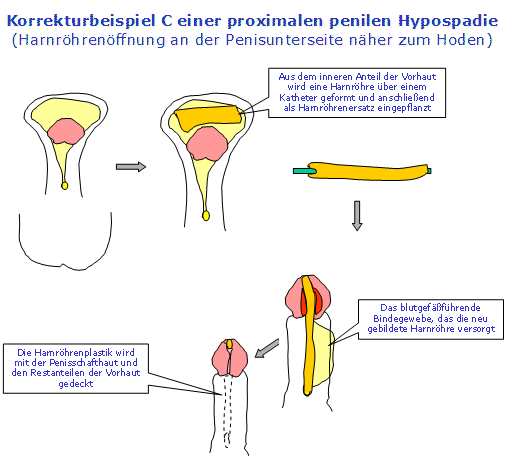 Beispiel einer Harnröhrenplastik