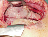 Pulmonary Disease
