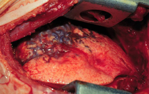 Pulmonary arteriovenous aneurysm