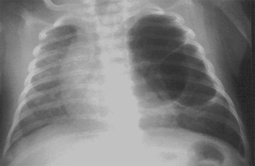 Congenizal pulmoary cysts with mediatinal shift