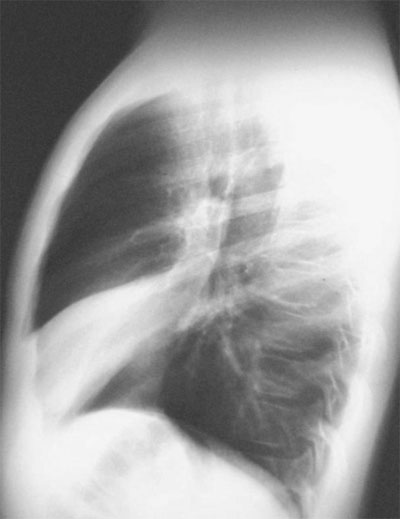 Typical right middle lobe atelectasis