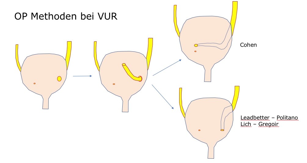 Vesicoureteraler Reflux (VUR) - 05