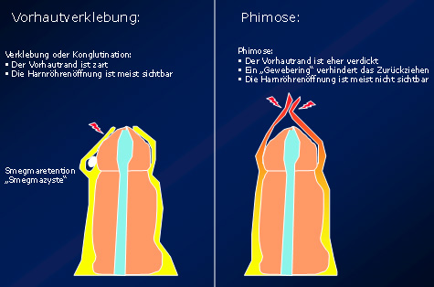 Weit die vorhaut muss zurück wie Penisvorhaut