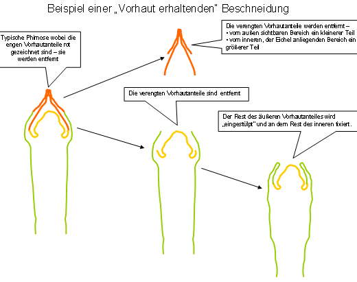 vorhaut reißt ein