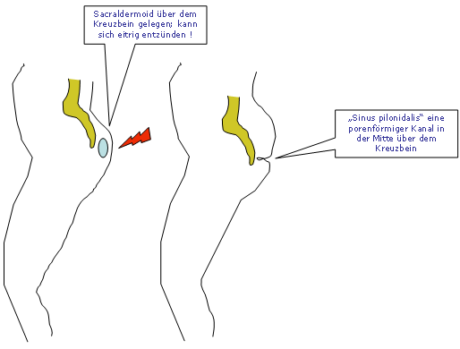 Steißbein abszess am Borreliose, Leistenbruch,