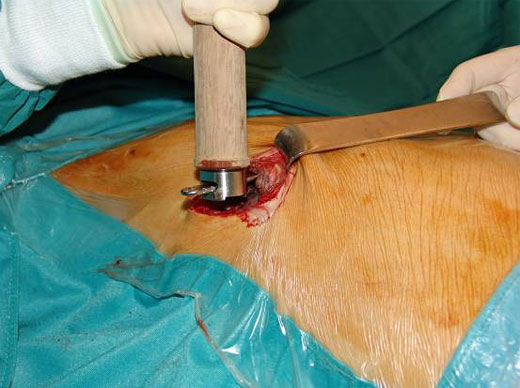 Trichterbrust - die Implantat-Entfernung nach 2 bis 3 Jahren