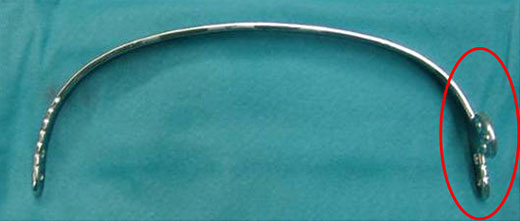 Das bereits gebogene und für die Implantation vorbereitete PS-Implantat mit integrierter einseitiger Stabilisatorlasche (roter Kreis).