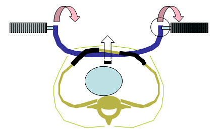 Prinzip der beidseitigen Implantatdrehung