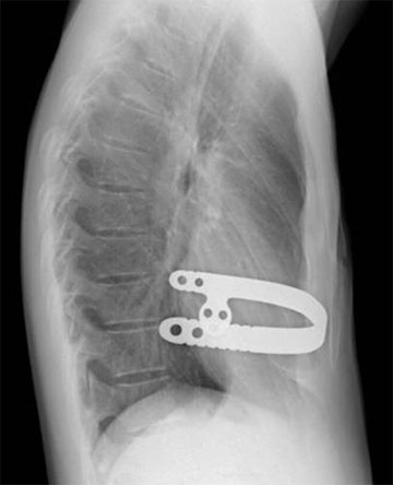 Seitliches Röntgen mit PS – Implantat (Fa. Hofer/Österreich).