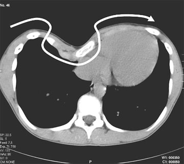 Pectus excavatum repair