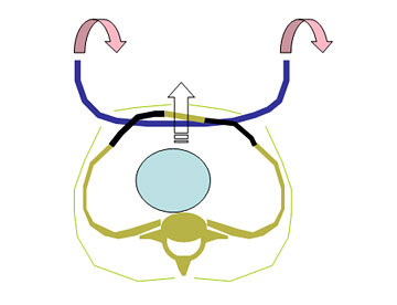 Pectus excavatum repair