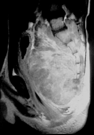 Ausgedehnter maligner Tumor vor dem Kreuzbein gelegen