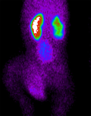 Szintigraphisch nachweisbarer Nierenschaden