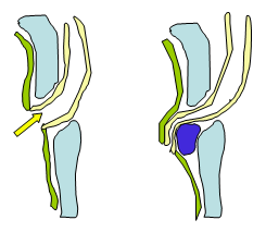 Endoskopische minimal invasive Antirefluxinjektion zur Herstellung des Ventilmechanismus